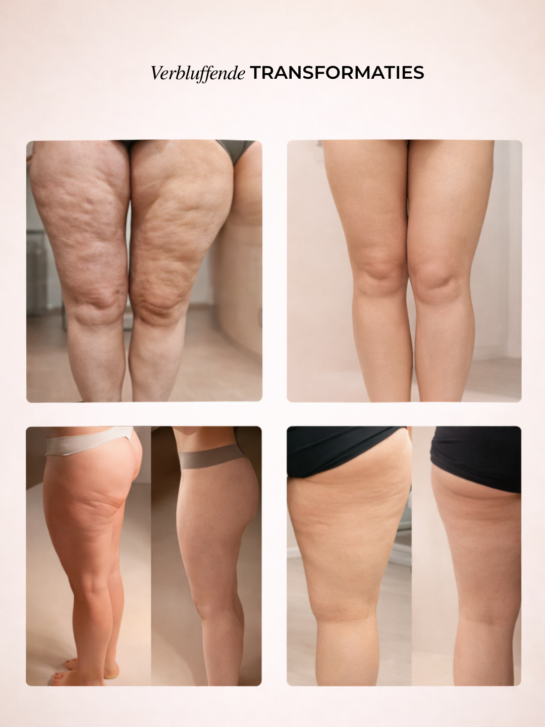 Norivae Contoura™ | Cellulite sichtbar von zu Hause aus reduzieren