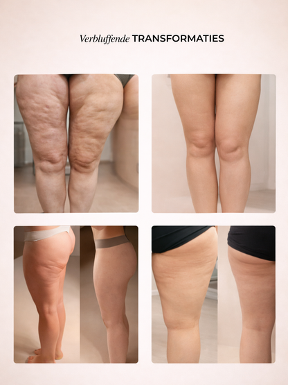 Norivae Contoura™ | Cellulite sichtbar von zu Hause aus reduzieren